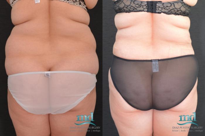 Before & After SAFE-Lipo® Case 8 View #5 View in Melbourne, FL