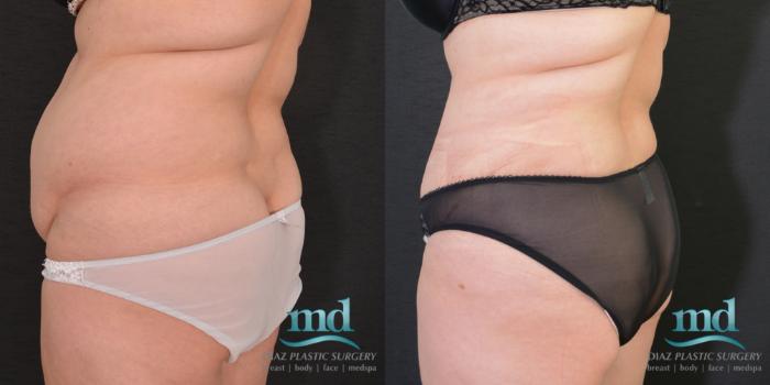 Before & After SAFE-Lipo® Case 8 View #6 View in Melbourne, FL