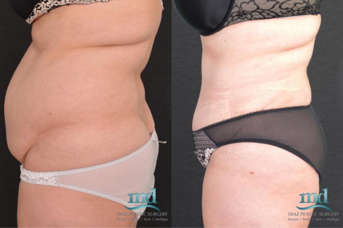 Before & After SAFE-Lipo® Case 8 View #7 View in Melbourne, FL