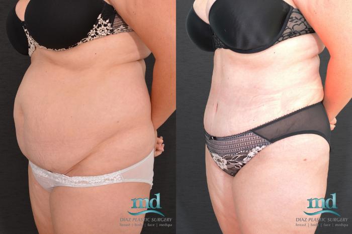 Before & After SAFE-Lipo® Case 8 View #8 View in Melbourne, FL