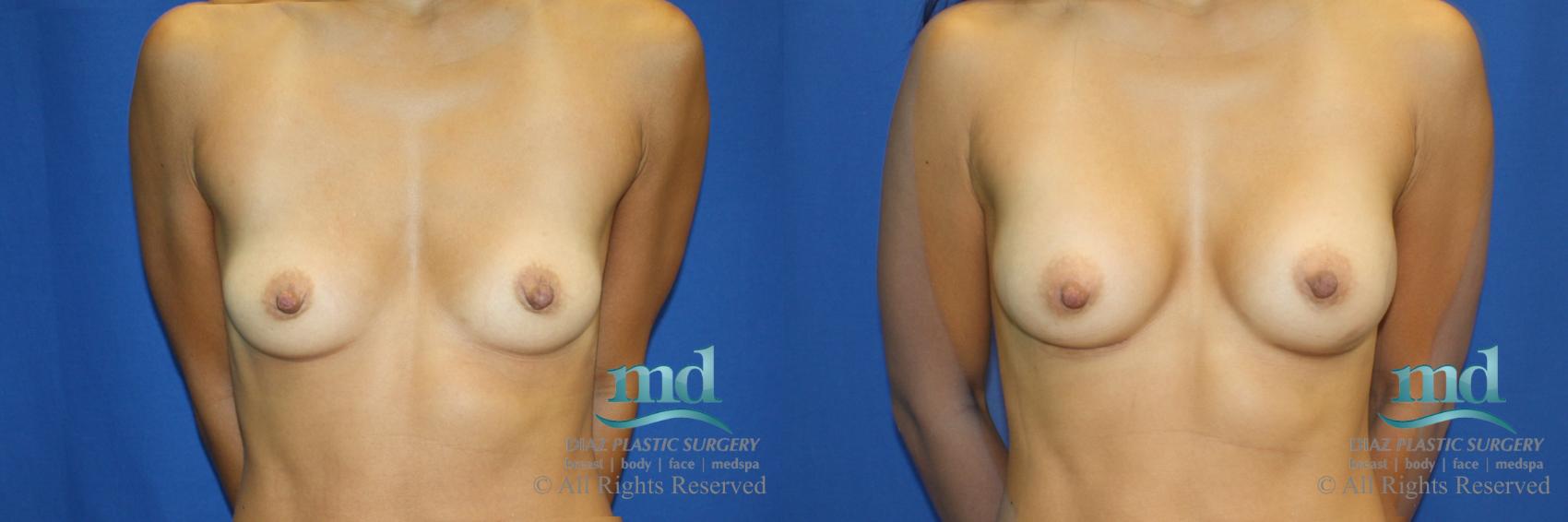 Before & After Shaped Gummy Bear Breast Implants Case 72 View #1 View in Melbourne, FL