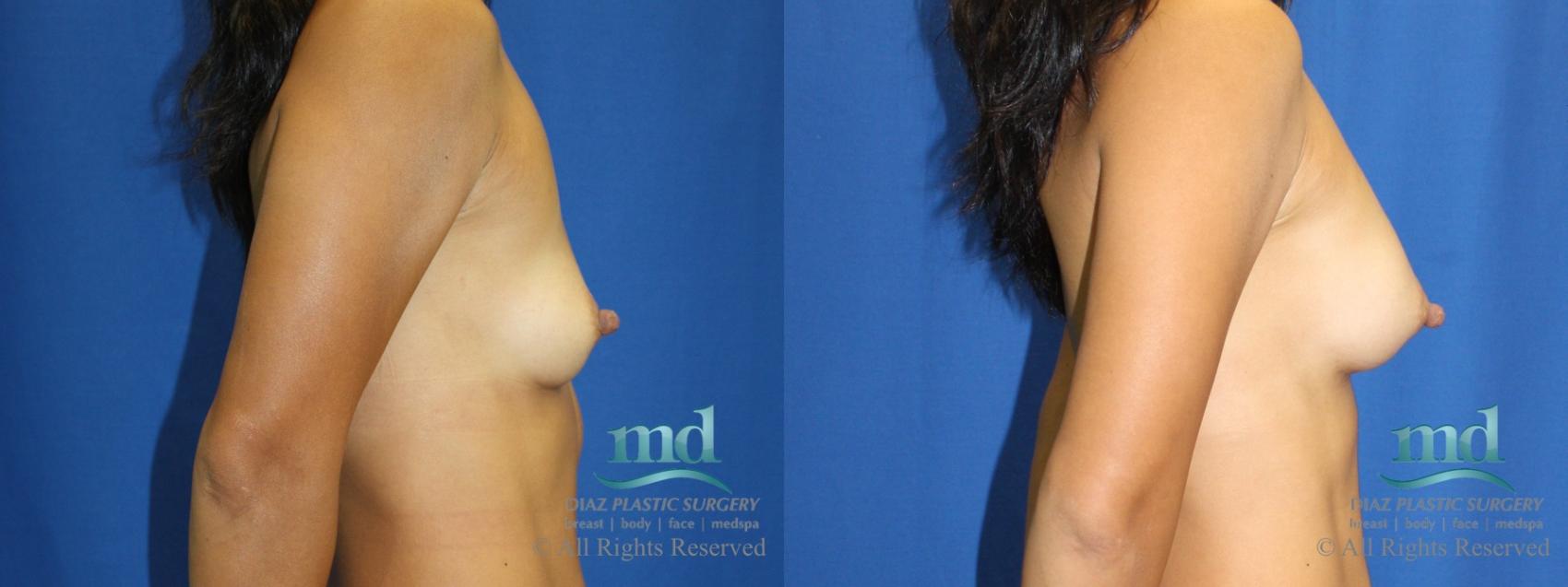 Before & After Shaped Gummy Bear Breast Implants Case 72 View #3 View in Melbourne, FL