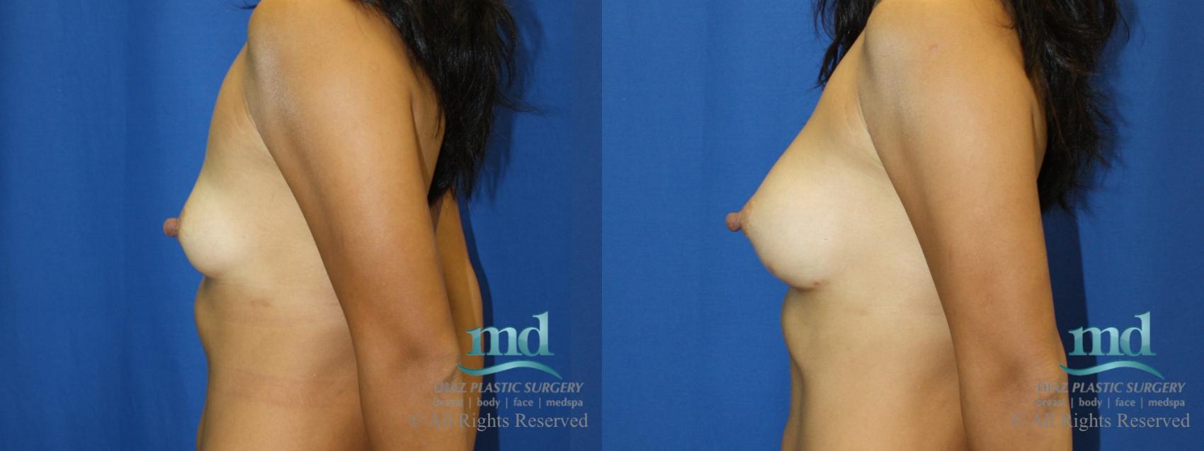 Before & After Shaped Gummy Bear Breast Implants Case 72 View #5 View in Melbourne, FL