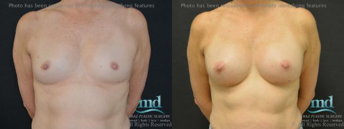 Before & After Shaped Gummy Bear Breast Implants Case 74 View #1 View in Melbourne, FL