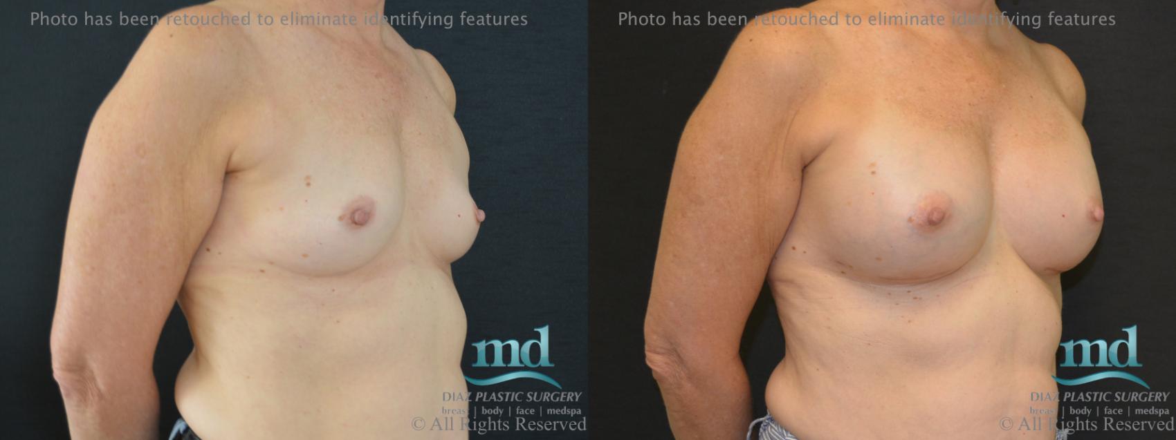 Before & After Shaped Gummy Bear Breast Implants Case 74 View #2 View in Melbourne, FL