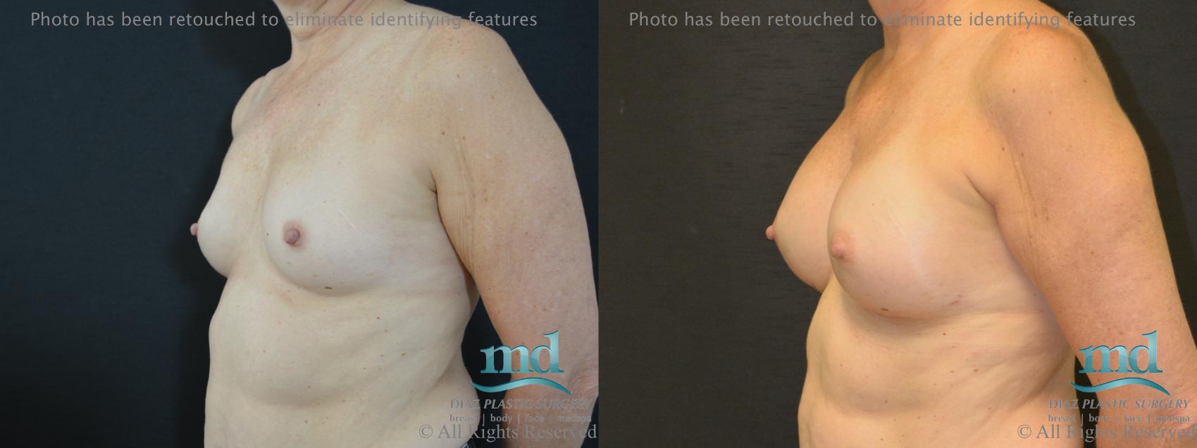 Before & After Shaped Gummy Bear Breast Implants Case 74 View #4 View in Melbourne, FL