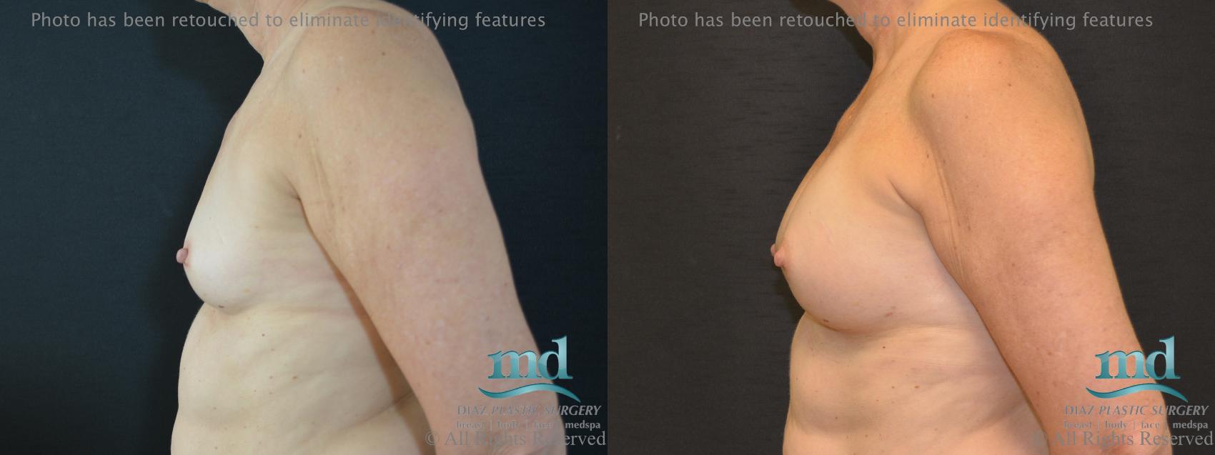Before & After Shaped Gummy Bear Breast Implants Case 74 View #5 View in Melbourne, FL