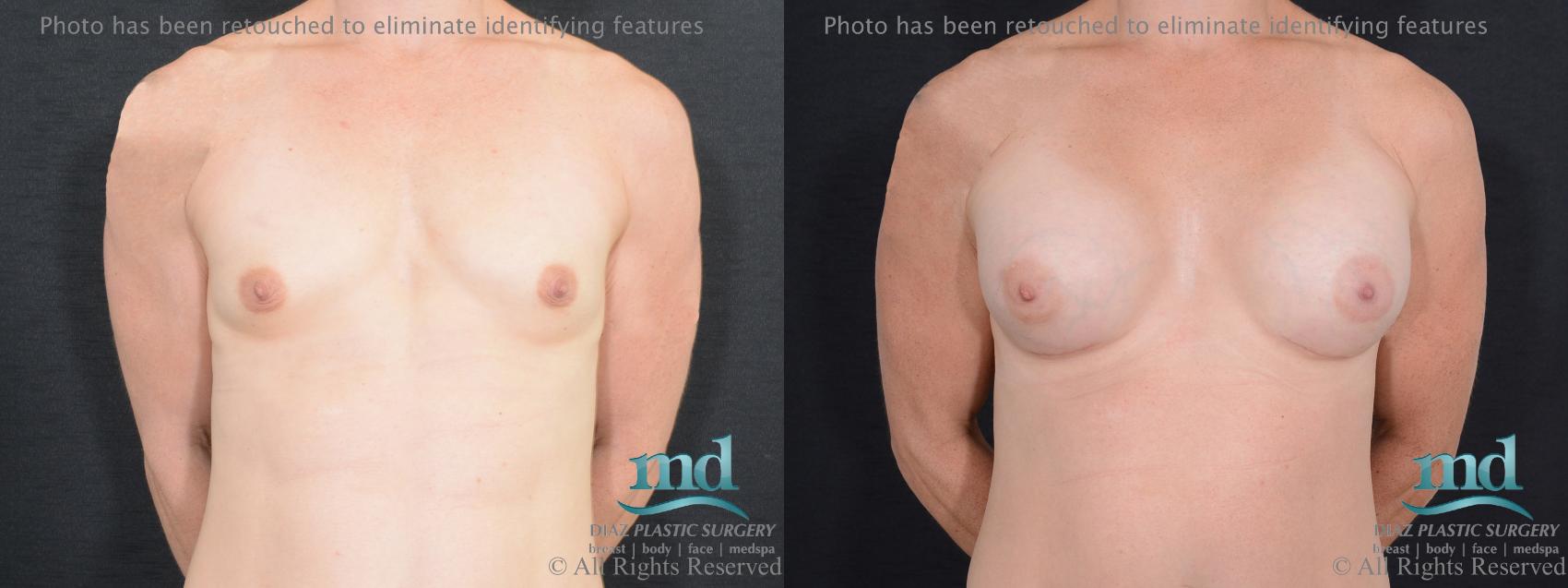 Before & After Shaped Gummy Bear Breast Implants Case 75 View #1 View in Melbourne, FL