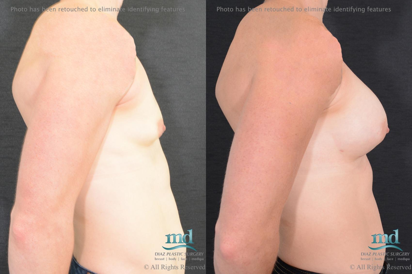 Before & After Shaped Gummy Bear Breast Implants Case 75 View #3 View in Melbourne, FL
