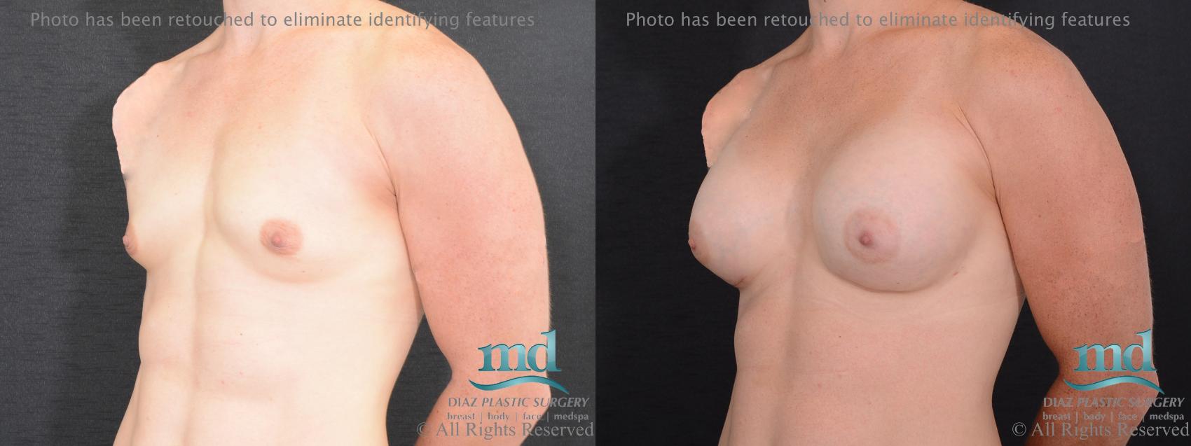 Before & After Shaped Gummy Bear Breast Implants Case 75 View #4 View in Melbourne, FL