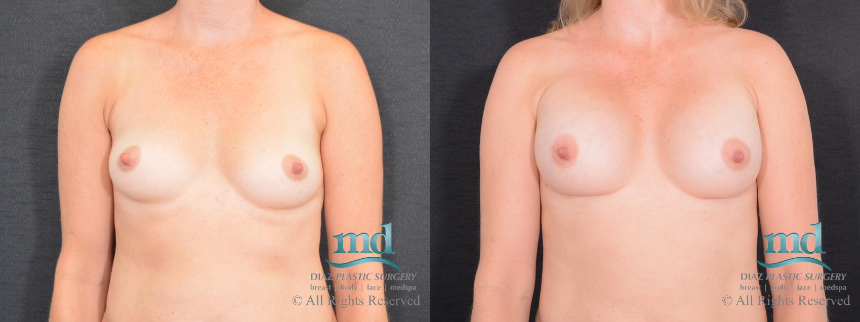 Before & After Shaped Gummy Bear Breast Implants Case 76 View #1 View in Melbourne, FL