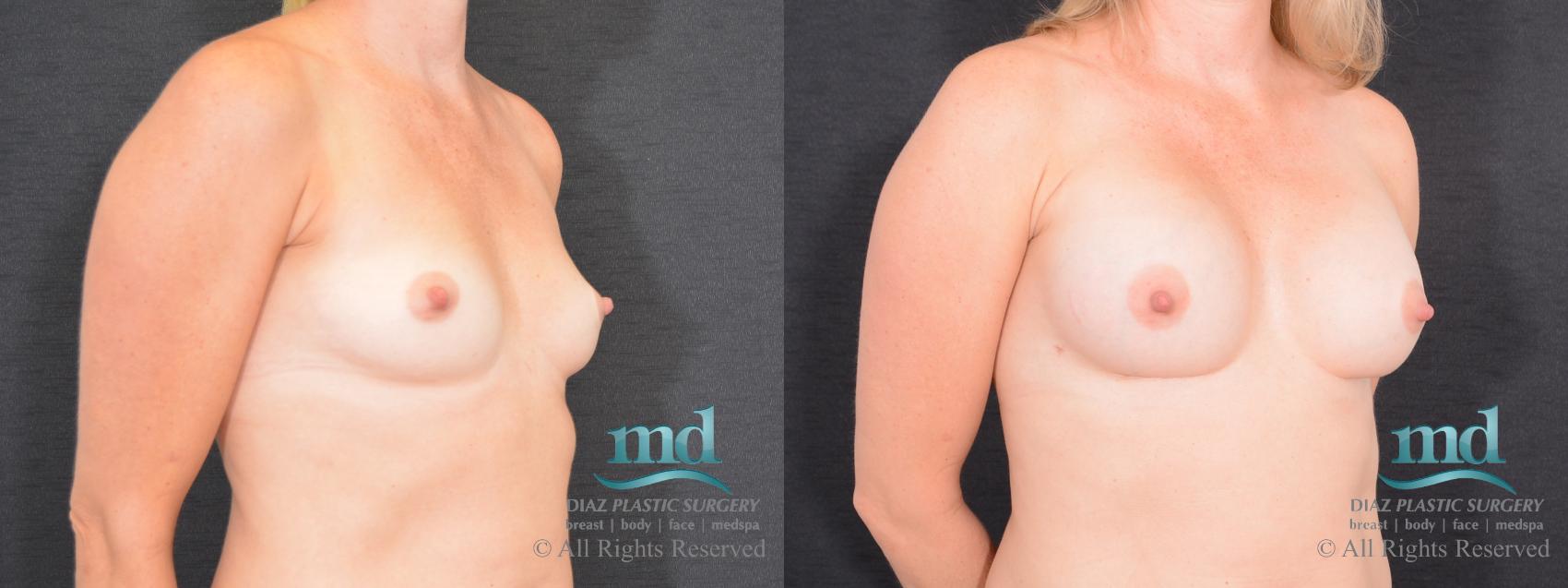 Before & After Shaped Gummy Bear Breast Implants Case 76 View #2 View in Melbourne, FL