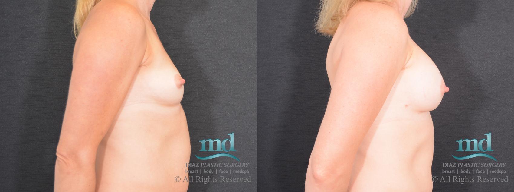 Before & After Shaped Gummy Bear Breast Implants Case 76 View #3 View in Melbourne, FL