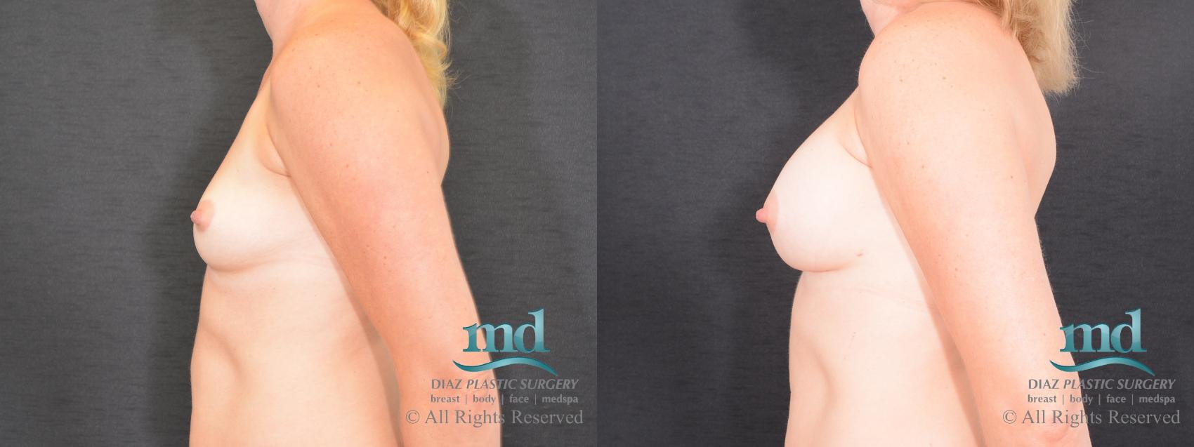 Before & After Shaped Gummy Bear Breast Implants Case 76 View #5 View in Melbourne, FL
