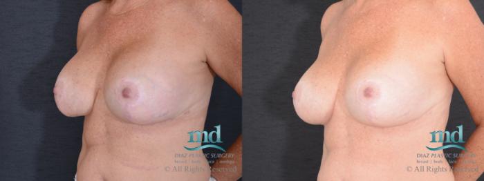 Before & After Strattice Revision Case 100 View #2 View in Melbourne, FL