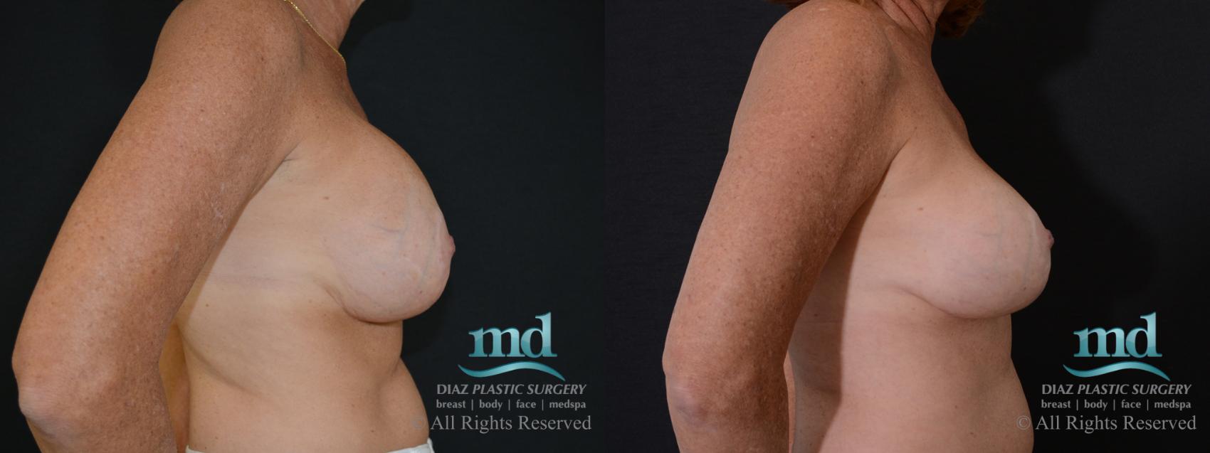 Before & After Strattice Revision Case 100 View #5 View in Melbourne, FL
