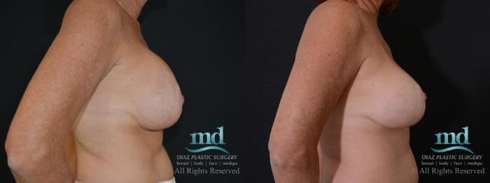 Before & After Strattice Revision Case 100 View #5 View in Melbourne, FL