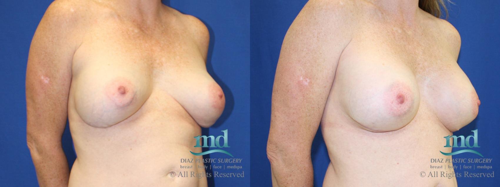 Before & After Strattice Revision Case 102 View #2 View in Melbourne, FL