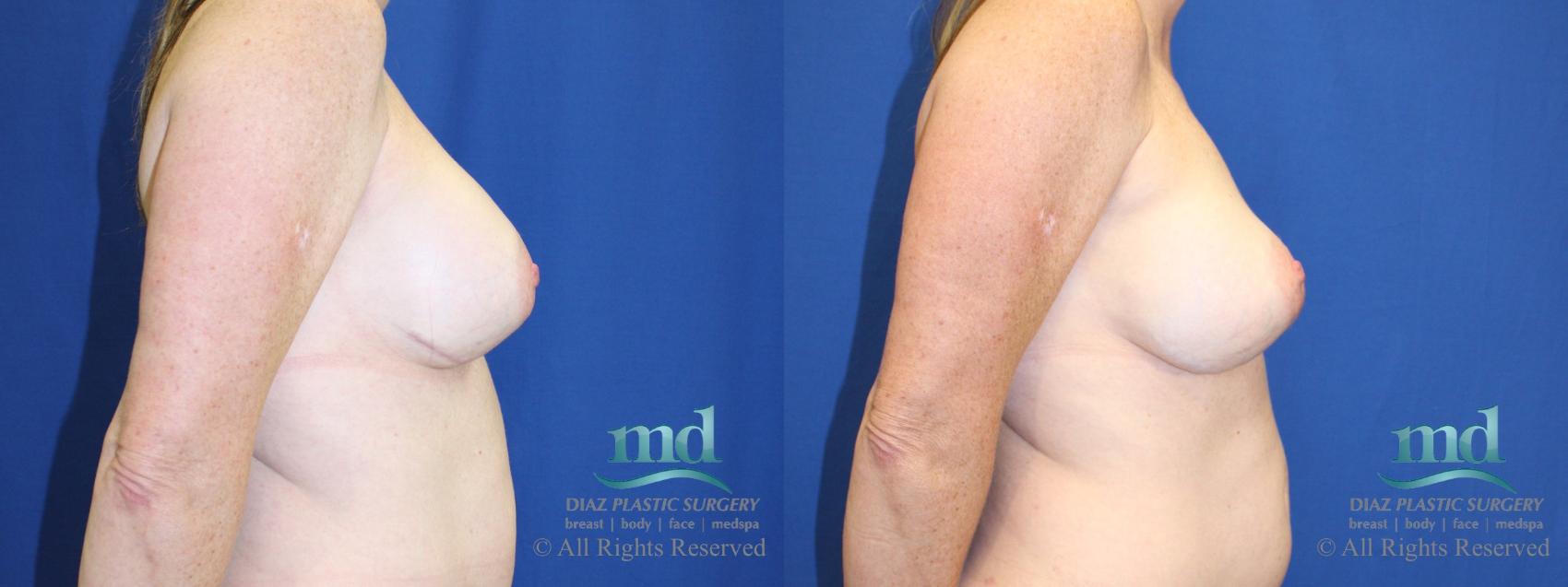 Before & After Strattice Revision Case 102 View #3 View in Melbourne, FL