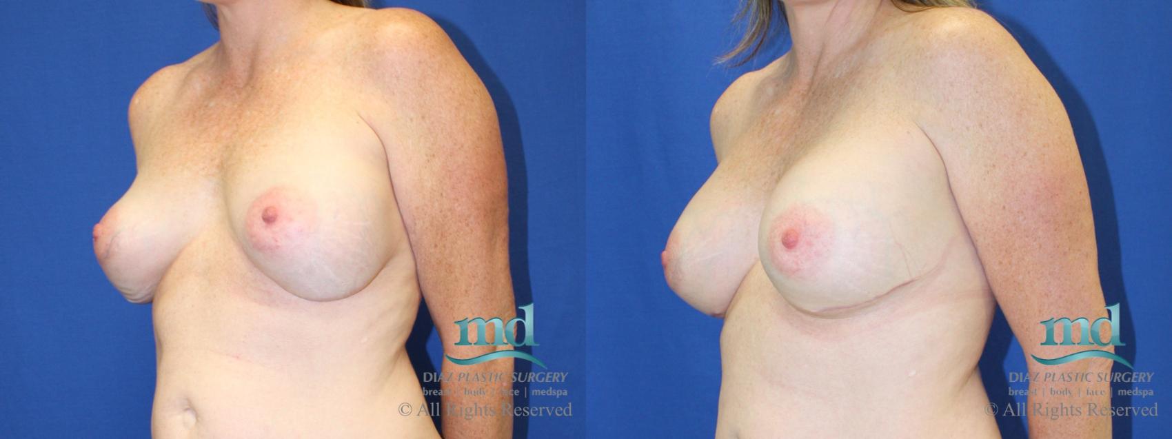 Before & After Strattice Revision Case 102 View #4 View in Melbourne, FL