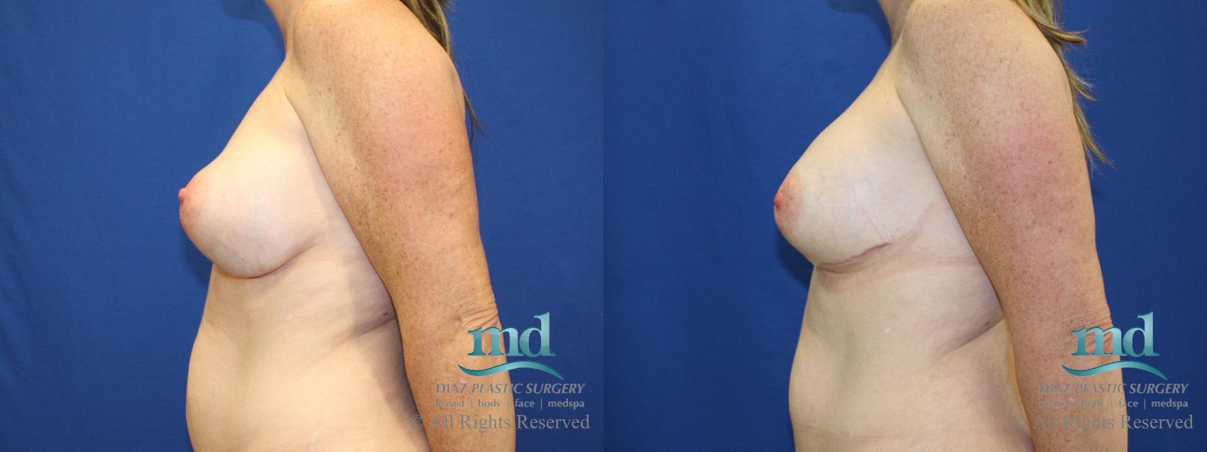 Before & After Strattice Revision Case 102 View #5 View in Melbourne, FL