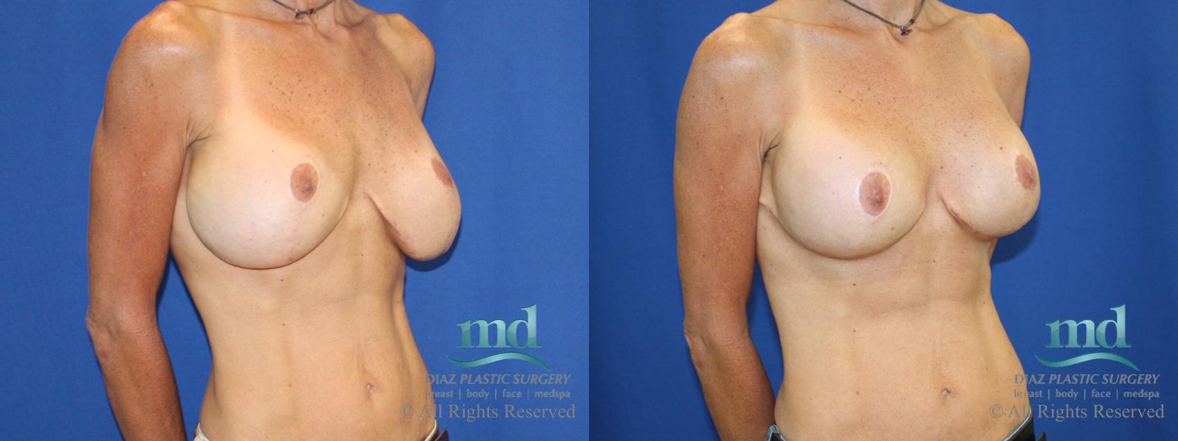 Before & After Strattice Revision Case 103 View #2 View in Melbourne, FL