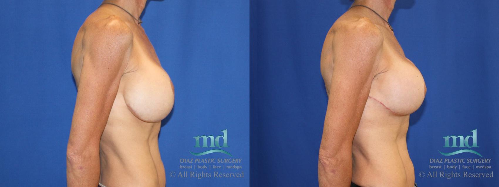 Before & After Strattice Revision Case 103 View #3 View in Melbourne, FL