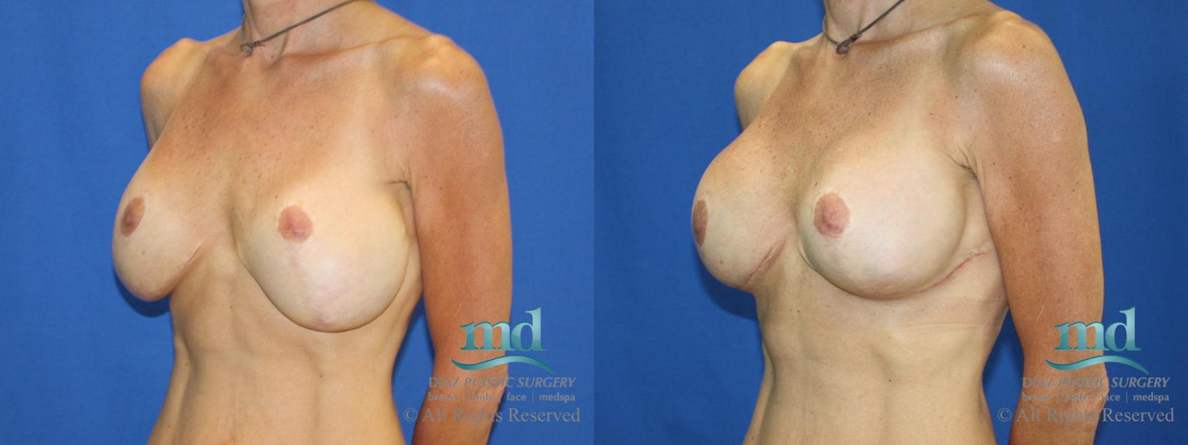Before & After Strattice Revision Case 103 View #4 View in Melbourne, FL