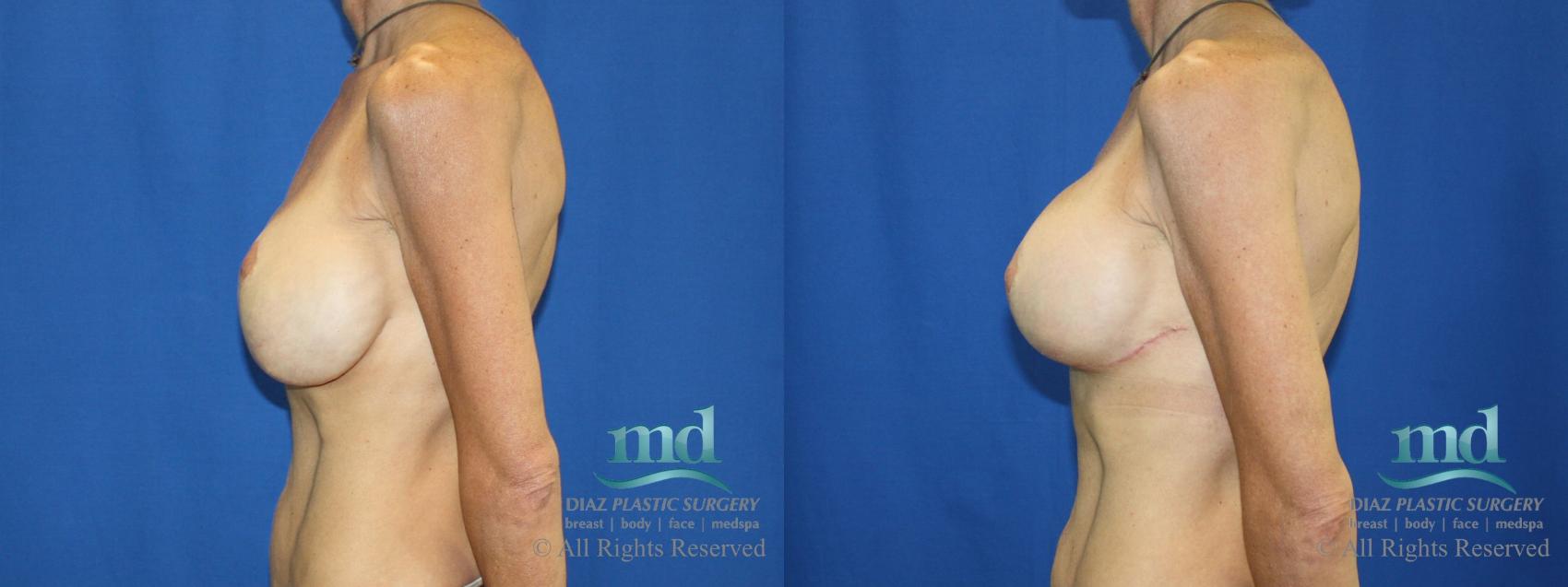 Before & After Strattice Revision Case 103 View #5 View in Melbourne, FL