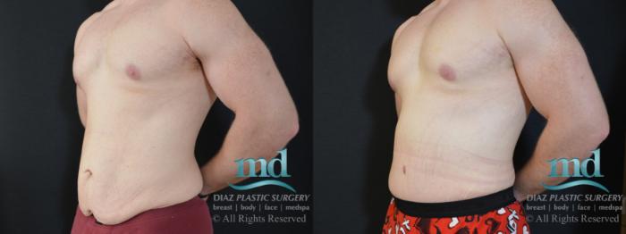 Before & After Surgery After Massive Weight Loss Case 124 View #2 View in Melbourne, FL