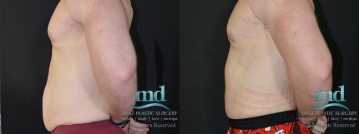 Before & After Surgery After Massive Weight Loss Case 124 View #3 View in Melbourne, FL