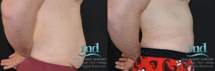 Before & After Surgery After Massive Weight Loss Case 124 View #4 View in Melbourne, FL