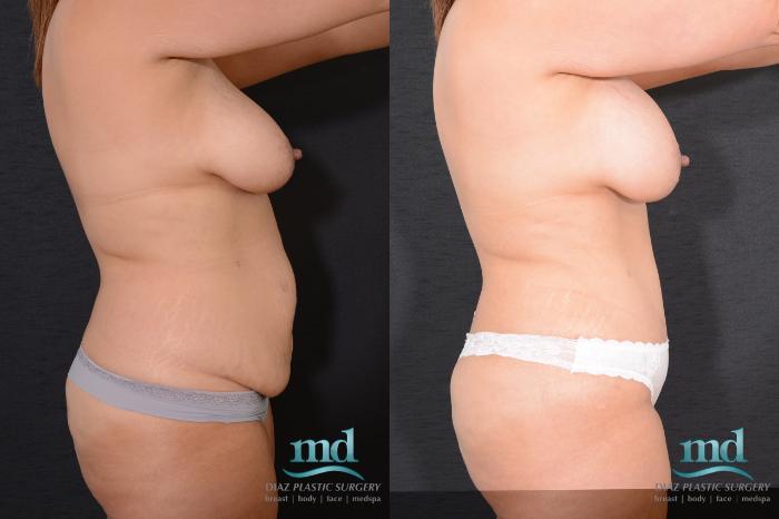 Before & After Surgery After Massive Weight Loss Case 16 View #4 View in Melbourne, FL