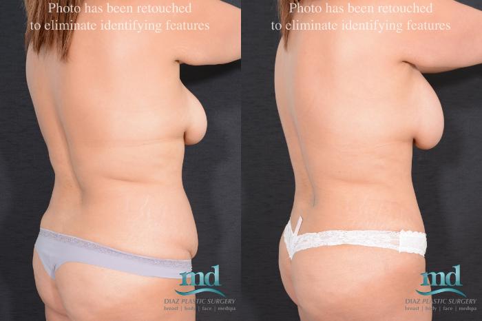 Before & After Surgery After Massive Weight Loss Case 16 View #5 View in Melbourne, FL