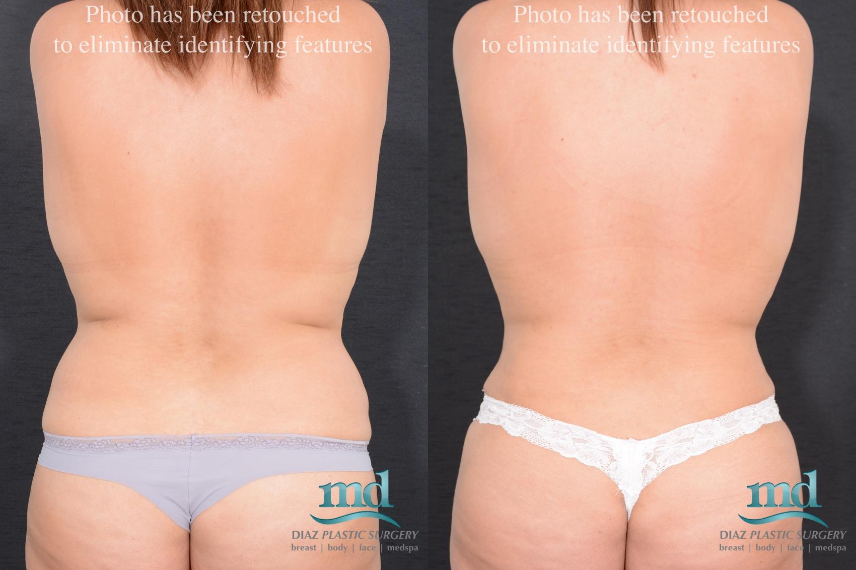 Before & After Surgery After Massive Weight Loss Case 16 View #6 View in Melbourne, FL