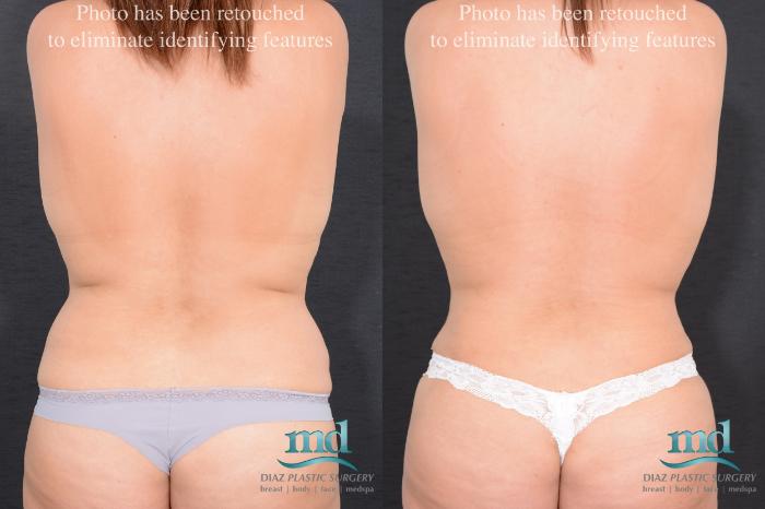 Before & After Surgery After Massive Weight Loss Case 16 View #6 View in Melbourne, FL
