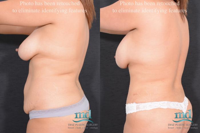 Before & After Surgery After Massive Weight Loss Case 16 View #7 View in Melbourne, FL