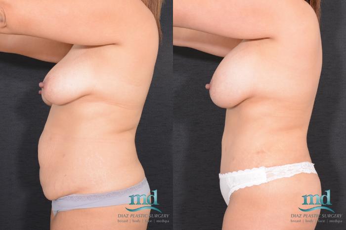 Before & After Surgery After Massive Weight Loss Case 16 View #8 View in Melbourne, FL