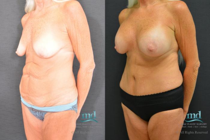 Before & After Surgery After Massive Weight Loss Case 98 View #2 View in Melbourne, FL