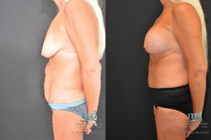 Before & After Surgery After Massive Weight Loss Case 98 View #3 View in Melbourne, FL