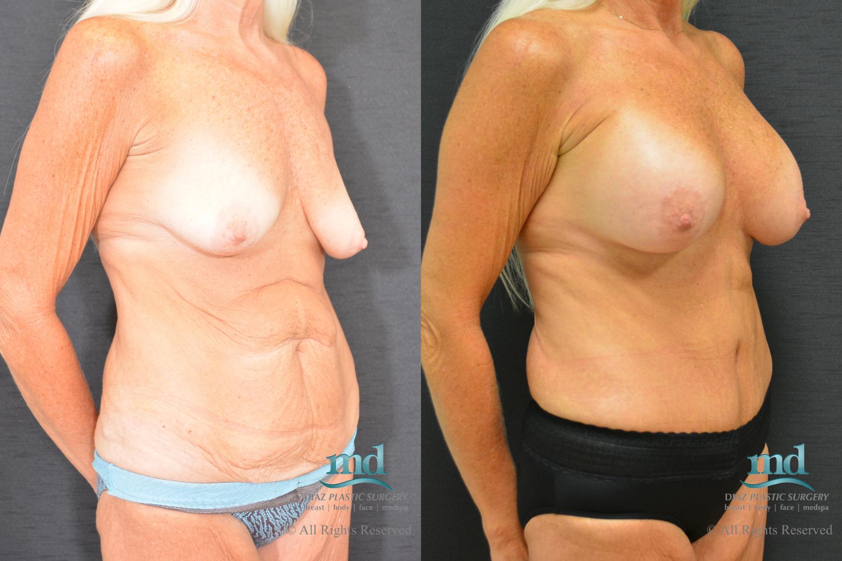 Before & After Surgery After Massive Weight Loss Case 98 View #4 View in Melbourne, FL
