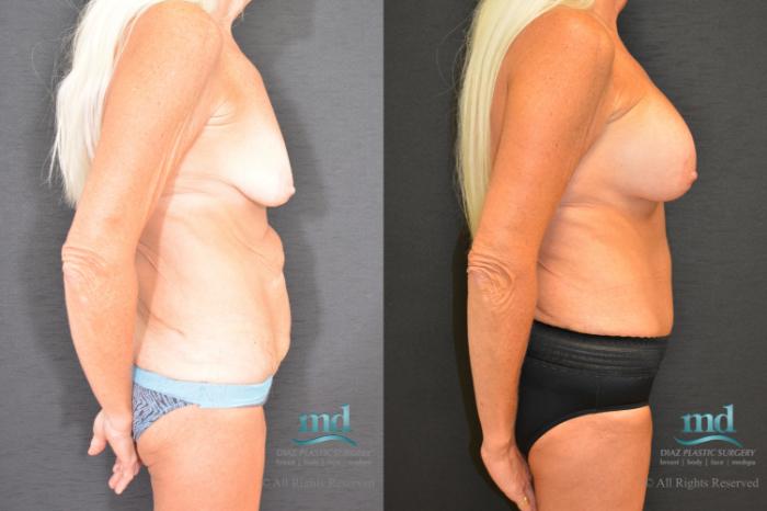 Before & After Surgery After Massive Weight Loss Case 98 View #5 View in Melbourne, FL