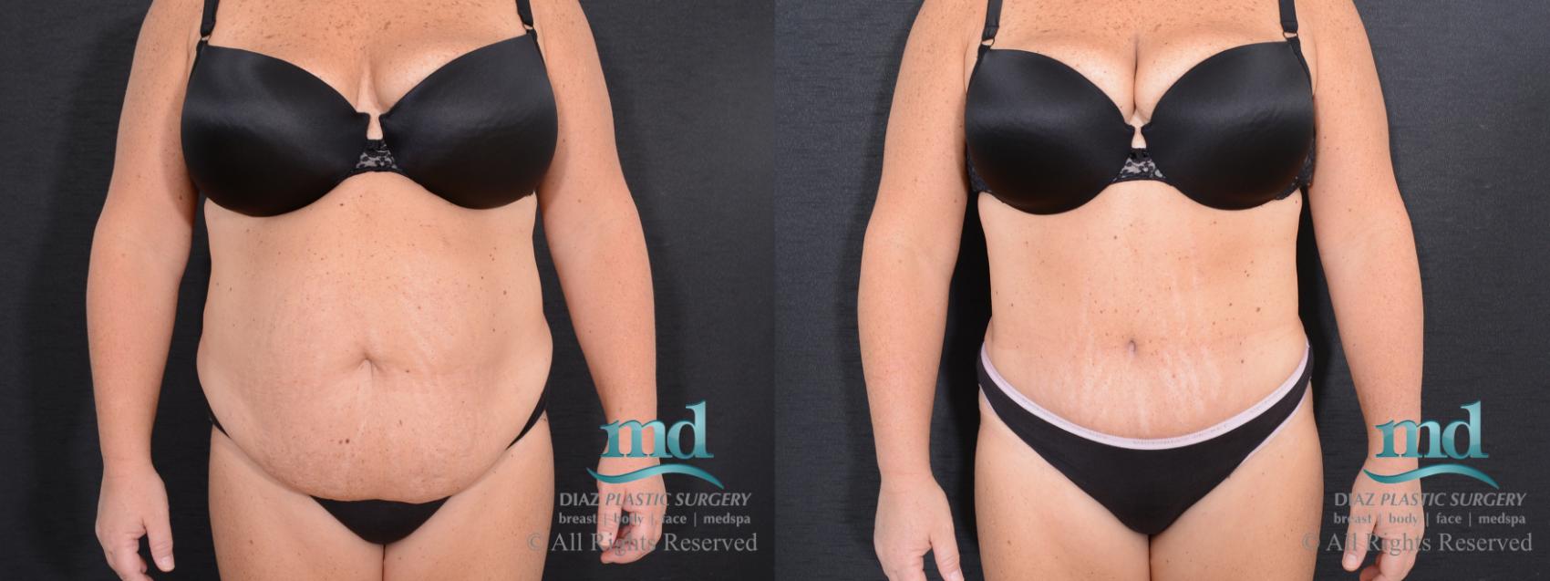 Before & After Tummy Tuck Case 17 View #1 View in Melbourne, Viera, Brevard County, FL