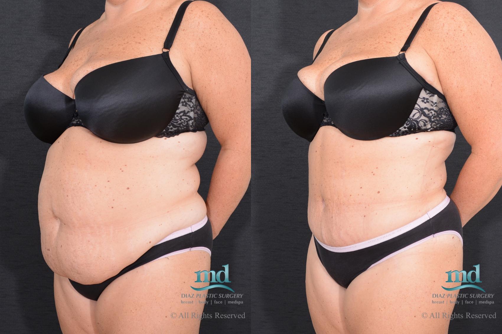 Before & After Tummy Tuck Case 17 View #2 View in Melbourne, FL