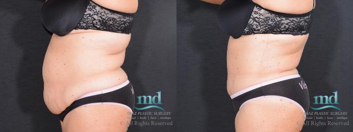 Before & After Tummy Tuck Case 17 View #3 View in Melbourne, FL
