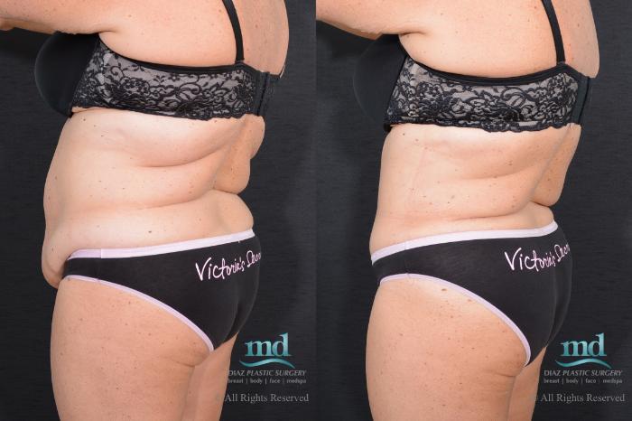 Before & After Tummy Tuck Case 17 View #4 View in Melbourne, FL