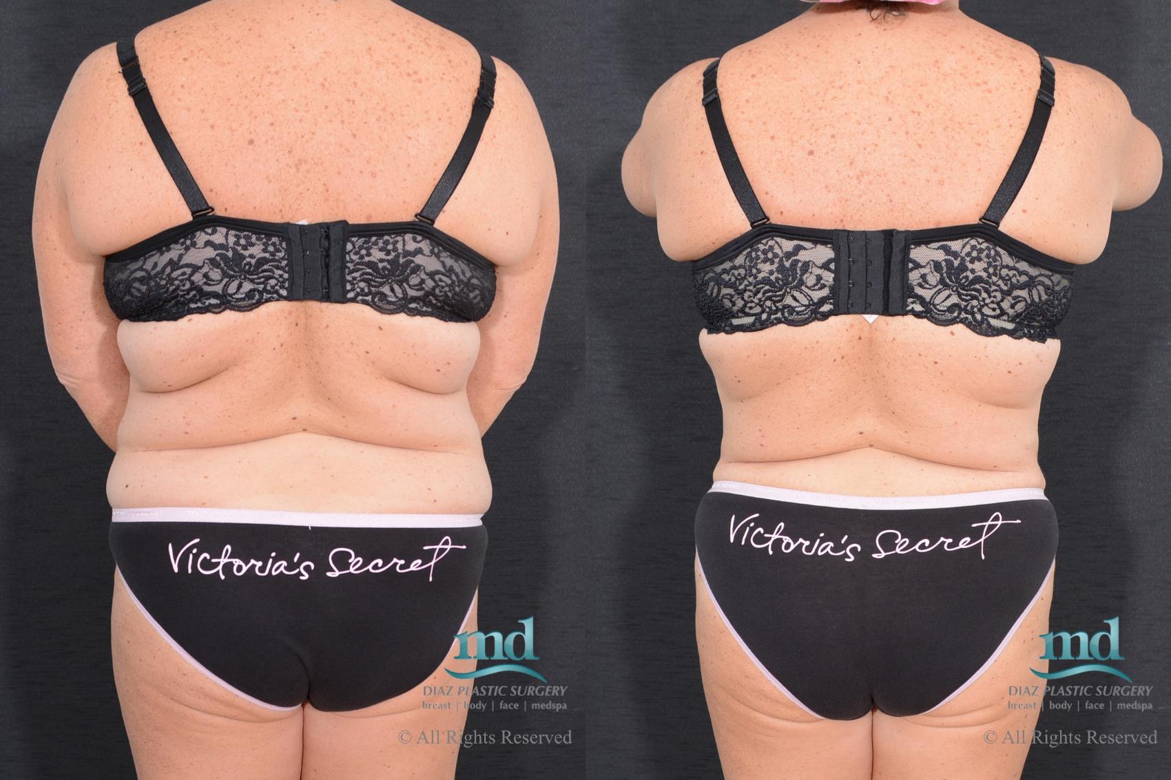 Before & After Tummy Tuck Case 17 View #5 View in Melbourne, FL