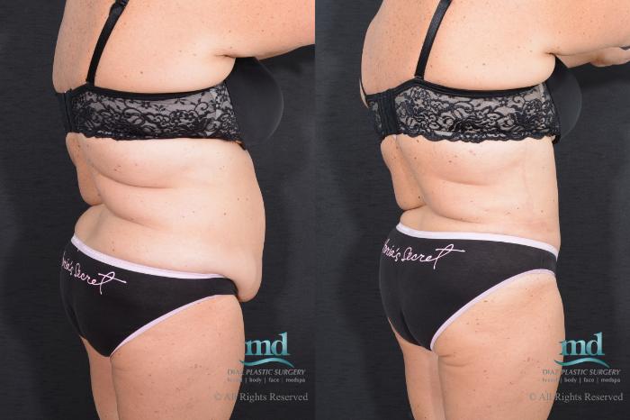 Before & After Tummy Tuck Case 17 View #6 View in Melbourne, FL