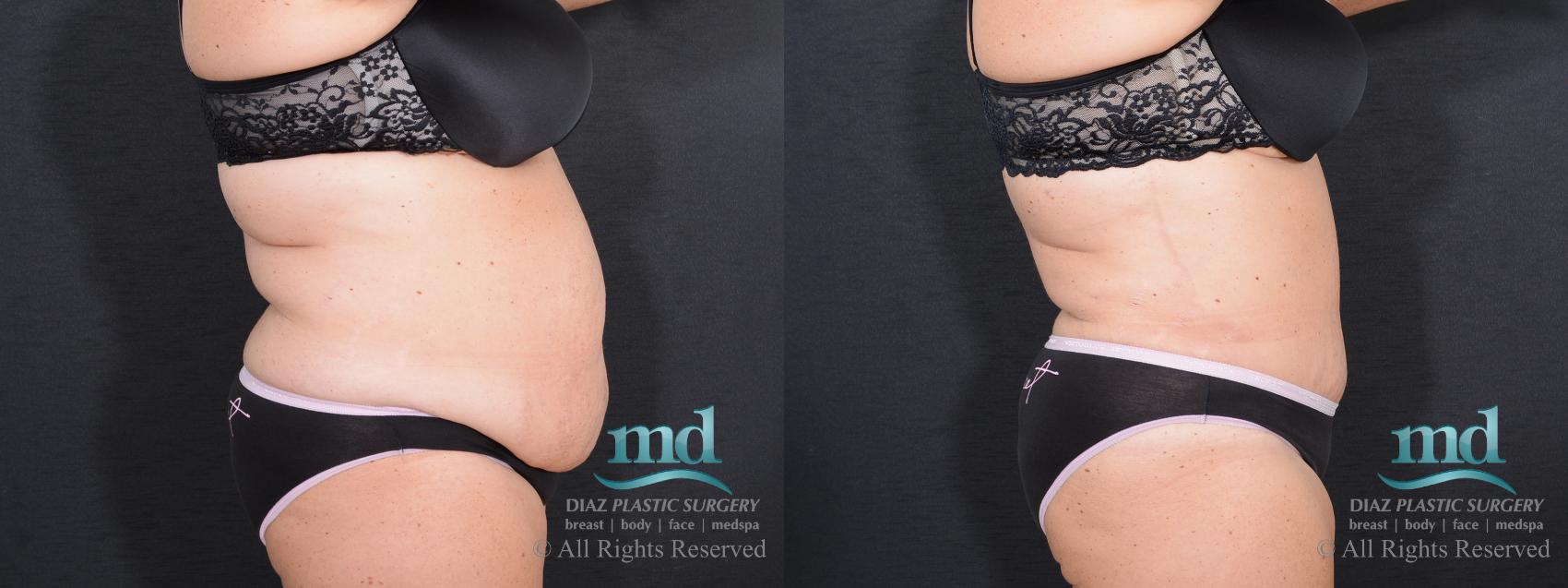 Before & After Tummy Tuck Case 17 View #7 View in Melbourne, FL
