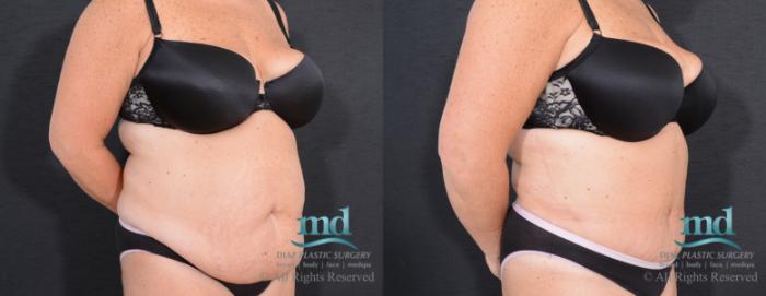 Before & After Tummy Tuck Case 17 View #8 View in Melbourne, FL